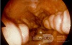 Esophageal Varices- Endoscopic Image