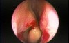 Anterior Bent Uncinate Process - Endoscopy