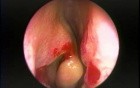 Anterior Bent Uncinate Process - Endoscopy