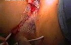 Posterior And Apical Vaginal Support With Mesh- Posterior Slingplasty