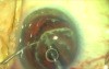 PAC: Femtosecond Laser vs Fugo Plasma Blade