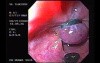 Banding of Esophageal Varices - Appearance of the Band