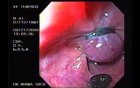 Banding of Esophageal Varices - Appearance of the Band
