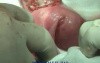Excision of Leiomyomas - Separation From Endometrium