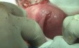 Excision of Leiomyomas - Separation From Endometrium