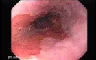 Endoscopic view of Barrett Esophagus -follow up endoscopy (8 of 9)