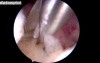 Hysteroscopic Excision of Polyps