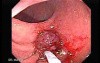 Endoscopic Appearance of Pedicled Polyp of the Descending Colon (5 of 7)