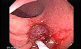 Endoscopic Appearance of Pedicled Polyp of the Descending Colon (5 of 7)