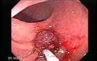 Endoscopic Appearance of Pedicled Polyp of the Descending Colon (5 of 7)