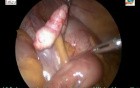 Single Incision Multi Port Laparoscopic Appendicectomy (SIMPLA)