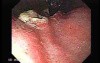 A Large Fungating and Ulcerating Lesion Presented at Gastric Fundus - Retroflexed View