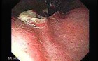 A Large Fungating and Ulcerating Lesion Presented at Gastric Fundus - Retroflexed View