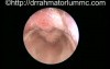 Congenital Vallecular Cyst - Endoscopic View