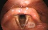 The Laryngeal Inlet