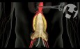 Improper Surgical Repair of Aortic Aneurysm