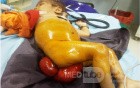 Rectal Prolapse In A Small Child - Other Shot