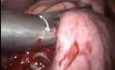 Laparoscopic sleeve gastrectomy