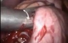 Laparoscopic sleeve gastrectomy