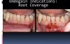 How To Aplicate Emdogain (Part 2)