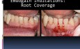 How To Aplicate Emdogain (Part 2)