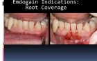 How To Aplicate Emdogain (Part 2)