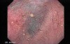Esophageal Diverticula - Insertion of the Endoscope