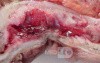 Rectal Adenocarcinoma (4 of 7)
