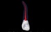 Maxillary Lateral Incisor - Root Canal Anatomy