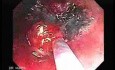 Endoscopic Resection of Giant Tubulo-Villous of the rectum (13 of 35)