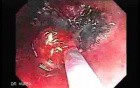 Endoscopic Resection of Giant Tubulo-Villous of the rectum (13 of 35)