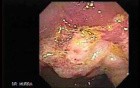 Cap polyposis that resemble a adenocarcinoma of the rectum (3 of 7)