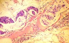 Endoscopy of Scirrhous Gastric Carcinoma involving the entire Fundus, Body and the Antrum (44 of 47)