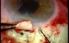 Baervelt shunt - procedure with use of Fugo Blade