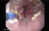 Endoscopic Ablation Of Barrett's Esophagus - 3/6