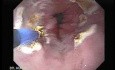 Endoscopic Ablation Of Barrett's Esophagus - 3/6