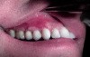 Gingival Grafting #3-6 Sites - Post-Op Healing - 2 Weeks Out
