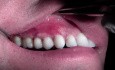 Gingival Grafting #3-6 Sites - Post-Op Healing - 2 Weeks Out