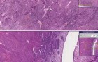 Senile atrophy - Histopathology - Endometrium