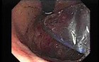 Achalasia - residual food (10 of 11)