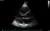 Real-Time Three Dimensional Echocardiography - Parasternal Long Axis View on Mitral Valve, Video nr 1
