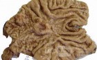 Adenocarcinoma of the Antrum and incisura angularis (4 of 12)