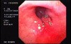 Flexible Endoscopic Suturing - End of The Gastroplication