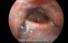 The Typical Laryngeal Endoscopy Appearance in Reflux Laryngitis