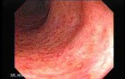 Crohn´s Colitis (3 of 3)