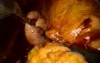 Paraesophageal Hernia Surgery