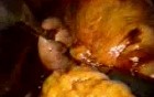 Paraesophageal Hernia Surgery