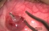 Inferior Oblique Myomectomy - Fugo Blade