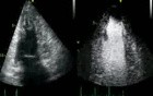 Cardiomyopathy