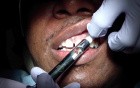 Almost Pain Free Local Anesthesia Anterior Maxilla: Step 1